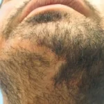 کاشت ریش برای جای زخم و اسکار