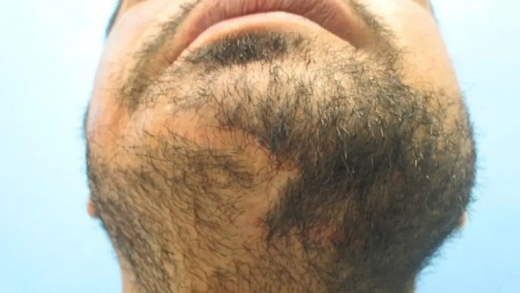 کاشت ریش برای جای زخم و اسکار