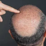 کاشت مو برای بانک موی ضعیف – واقعاً شدنیه؟