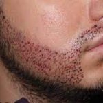 کاشت ریش طبیعی چیست و چطور انجام می‌شود؟